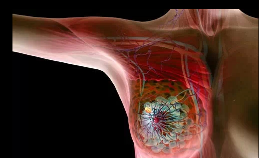 四大因素易诱发乳腺癌