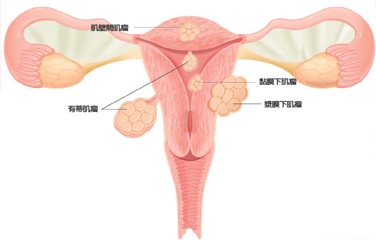 子宫肌瘤百科