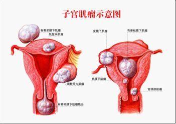 子宫肌瘤常见症状有哪些?